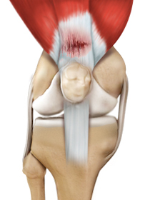 Tendon & Ligament Injuries - Educational Picture