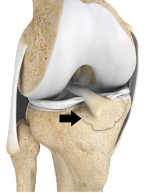 Tibial Eminence Fracture - Educational Picture