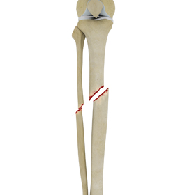 Tibial Shaft Fracture - Educational Picture