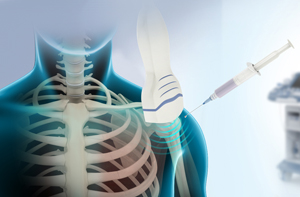 Ultrasound-Guided Shoulder Injections - Educational Picture
