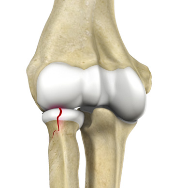Upper and Lower Extremity Fracture Care - Educational Picture