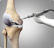 Robotic-Assisted Knee Replacement img