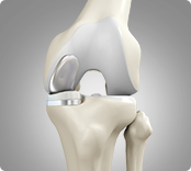 Unicondylar/Partial Knee Replacement img