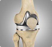 Outpatient Total Knee Replacement img