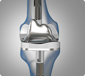 Revision Knee Replacement img