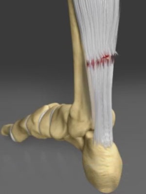 Achilles Tendon Rupture - image