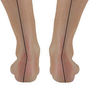 Adult Acquired Flatfoot - image