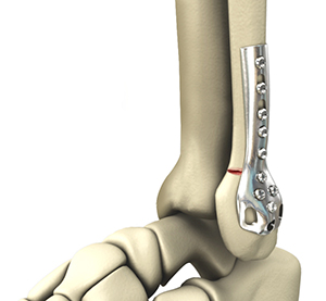 Ankle Fracture Surgery - image