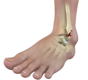 Ankle Fractures - image