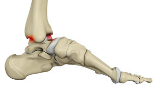 Ankle Impingement - image