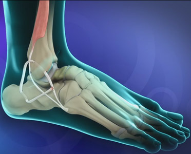 Ankle Ligament Reconstruction - image