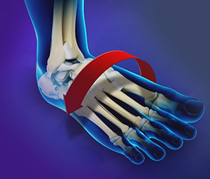 Ankle Stabilization - image