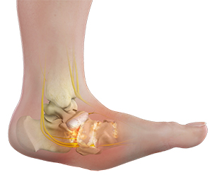 Charcot Foot Deformity - image