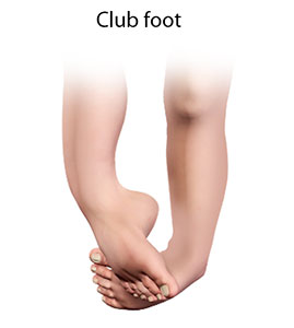 Clubfoot - image