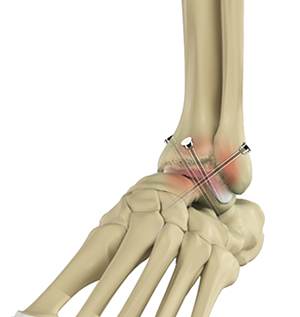 Foot and Ankle Surgery - image