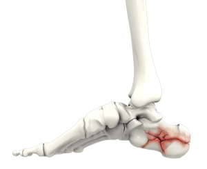 Foot Fracture - image