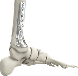 Foot Reconstruction - image