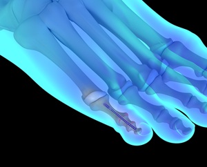 Hammertoe Surgery