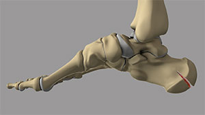 Heel Fractures - image
