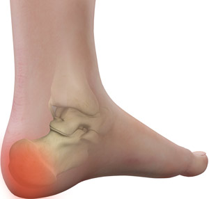 Heel Pain - image