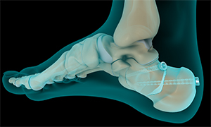 Internal and External Fixation of Foot and Ankle Fractures - image