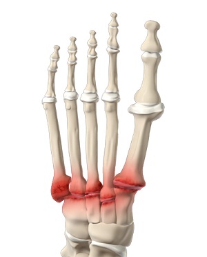 Midfoot Arthritis - image