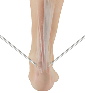 Minimally Invasive Achilles Repair - image