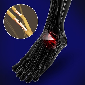 Nerve Conditions of the Foot - image