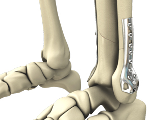 Open Reduction and Internal Fixation of the Ankle - image