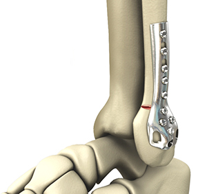 Open Reduction and Internal Fixation of the Foot - image