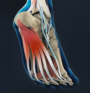Plantar Fascia Release - image