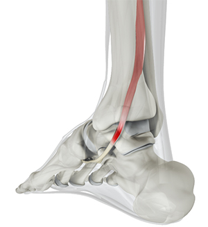 Posterior Tibial Tendon Dysfunction