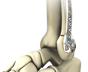 Revision Foot and Ankle Surgery - image
