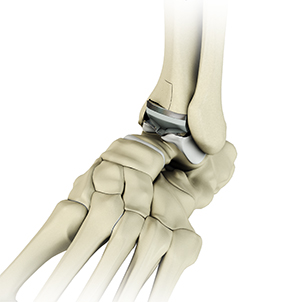 Revision Total Ankle Replacement