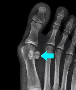Sesamoid Fracture - image