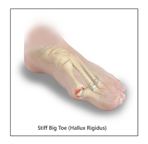 Stiff Big Toe (Hallux Rigidus) - image