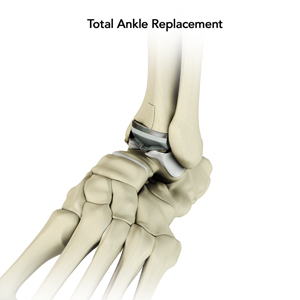 Total Ankle Replacement - image