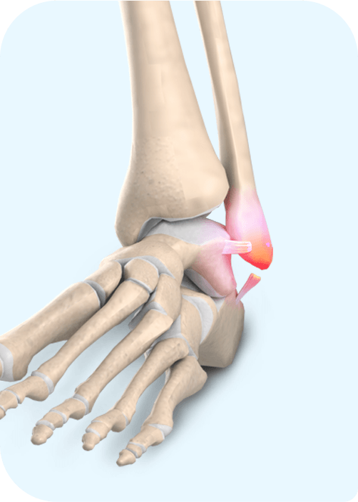 Sports Injuries