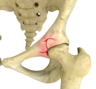 Acetabular Fracture - Educational Picture