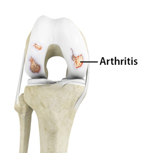 Arthritis - Educational Picture