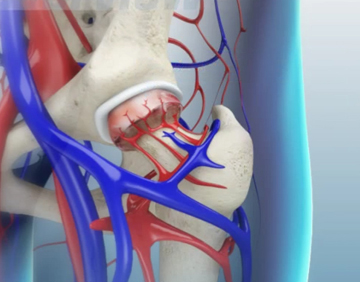 Avascular Necrosis - Educational Picture