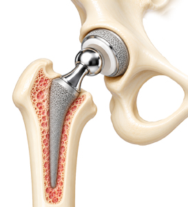 Cementless Hip Replacement - Educational Picture