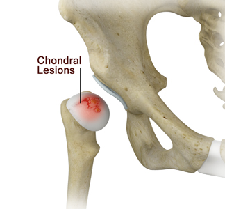 Chondral Lesions or Injuries of the Hip - Educational Picture