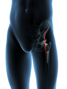 Direct Anterior Hip Replacement - Educational Picture