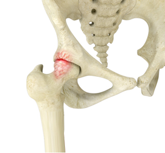Femoroacetabular Impingement - Educational Picture