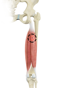 Hamstring Injuries - Educational Picture