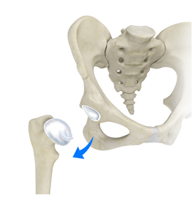Hip Dislocation - Educational Picture