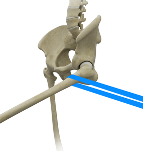 Hip Distraction - Educational Picture