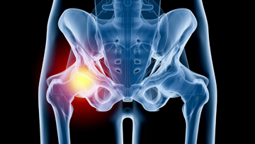 Hip Injury - Educational Picture
