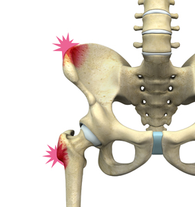 Hip Pointer - Educational Picture